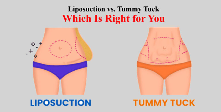Liposuction vs. Tummy Tuck