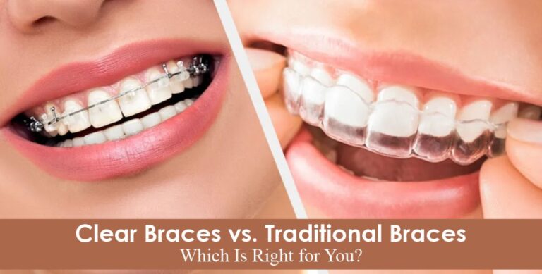 Clear Braces vs Traditional Braces