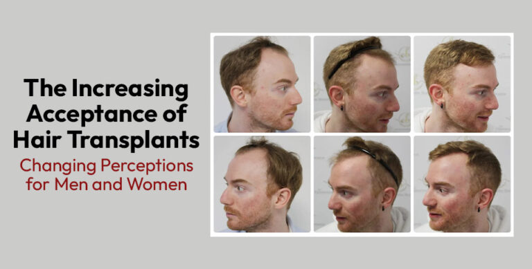 Increasing Acceptance of Hair Transplants