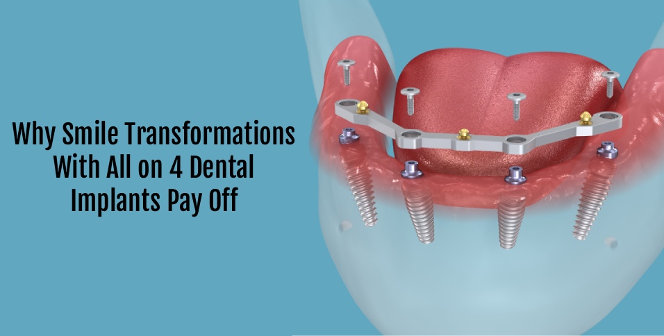 Dental Implants Pay Off