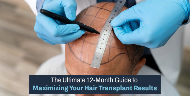 The Ultimate 12-Month Guide to Maximizing Your Hair Transplant Results